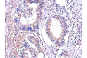 IHC-P Image Immunohistochemical analysis of paraffin-embedded human gastric cancer, using P2Y7, antibody at 1:500 dilution. (Leukotriene B4 Receptor/BLT antibody)
