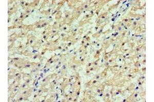 Immunohistochemistry of paraffin-embedded human liver cancer using ABIN7154092 at dilution of 1:100 (GSTa2 antibody  (AA 1-222))