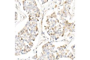 Immunohistochemistry of paraffin-embedded human breast cancer using /AMID Rabbit pAb (ABIN6129888, ABIN6136678, ABIN6136679 and ABIN6215707) at dilution of 1:25 (40x lens). (AIFM2 antibody  (AA 1-373))
