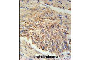 EBPL Antibody immunohistochemistry analysis in formalin fixed and paraffin embedded human lung carcinoma followed by peroxidase conjugation of the secondary antibody and DAB staining.