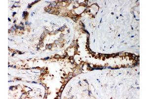 Anti- PP2A-alpha Picoband antibody, IHC(P) IHC(P): Human Lung Cancer Tissue (PPP2CA antibody  (AA 1-309))