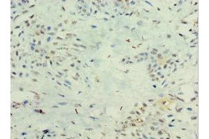 Immunohistochemistry of paraffin-embedded human breast cancer using ABIN7156607 at dilution of 1:100 (IL29 antibody  (AA 20-200))