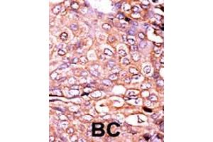 Formalin-fixed and paraffin-embedded human cancer tissue reacted with EP300 (phospho S89) polyclonal antibody  which was peroxidase-conjugated to the secondary antibody followed by AEC staining. (p300 antibody  (pSer89))
