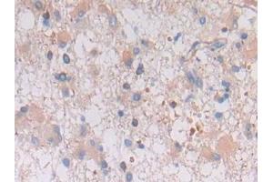 Detection of GFAP in Human Glioma Tissue using Polyclonal Antibody to Glial Fibrillary Acidic Protein (GFAP) (GFAP antibody  (AA 256-357))