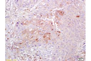 Formalin-fixed and paraffin embedded human lung carcinoma labeled with Anti Integrin alpha 3 Polyclonal Antibody , Unconjugated at 1:200, followed by conjugation to the secondary antibody and DAB staining (ITGA3 antibody  (AA 976-1025))