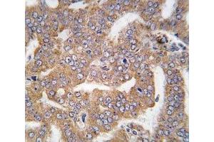 IHC analysis of FFPE human prostate carcinoma tissue stained with PAK4 antibody (PAK4 antibody  (AA 156-187))
