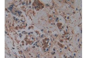 DAB staining on IHC-P; Samples: Human Breast cancer Tissue (GMFG antibody  (AA 6-126))