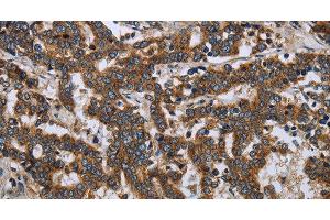 Immunohistochemistry of paraffin-embedded Human liver cancer tissue using LGALS2 Polyclonal Antibody at dilution 1:30 (Galectin 2 antibody)