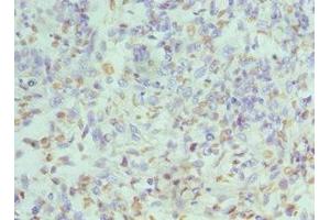 Immunohistochemistry of paraffin-embedded human endometrial cancer using ABIN7155102 at dilution of 1:100 (HNRNPD/AUF1 antibody  (AA 1-306))