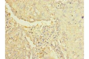 Immunohistochemistry of paraffin-embedded human lung cancer using ABIN7143633 at dilution of 1:100