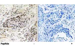 Immunohistochemistry analysis of paraffin-embedded human lung carcinoma tissue using APBA2 polyclonal antibody . (APBA2 antibody)