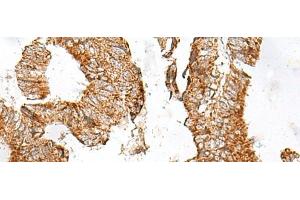 Immunohistochemistry of paraffin-embedded Human colorectal cancer tissue using GPR119 Polyclonal Antibody at dilution of 1:45(x200) (G Protein-Coupled Receptor 119 antibody)