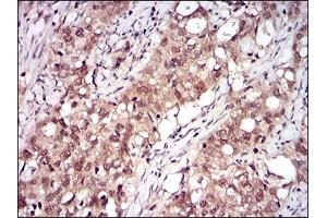 Immunohistochemical analysis of paraffin-embedded human cervical cancer tissues using RELB mouse mAb with DAB staining. (RELB antibody  (AA 273-443))