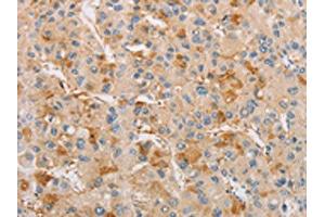 The image on the left is immunohistochemistry of paraffin-embedded Human liver cancer tissue using ABIN7128532(ARSF Antibody) at dilution 1/20, on the right is treated with fusion protein. (ARSF antibody)