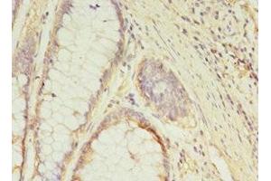 Immunohistochemistry of paraffin-embedded human colon cancer using ABIN7154452 at dilution of 1:100 (GCC1 antibody  (AA 4-775))