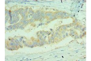 Immunohistochemistry of paraffin-embedded human colon cancer using ABIN7159680 at dilution of 1:100 (MICA antibody  (AA 24-307))