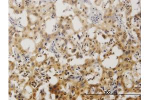 Immunoperoxidase of monoclonal antibody to ZNF496 on formalin-fixed paraffin-embedded human cholangiocarcinoma. (ZNF496 antibody  (AA 485-585))