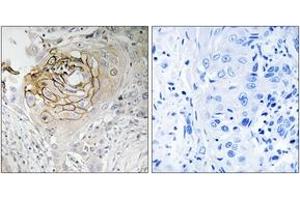 Immunohistochemistry analysis of paraffin-embedded human lung carcinoma tissue, using SCN9A Antibody. (SCN9A antibody  (AA 651-700))