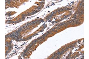The image on the left is immunohistochemistry of paraffin-embedded Human colon cancer tissue using ABIN7190865(GREB1 Antibody) at dilution 1/40, on the right is treated with synthetic peptide. (GREB1 antibody)