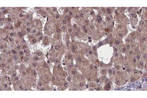 ABIN6277461 at 1/100 staining Human liver cancer tissue by IHC-P. (SSTR2 antibody  (C-Term))