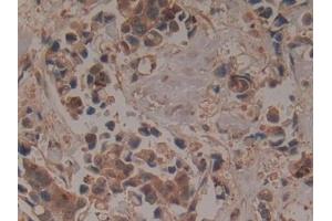 Detection of GCLM in Human Breast cancer Tissue using Polyclonal Antibody to Glutamate Cysteine Ligase, Modifier Subunit (GCLM)