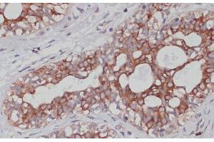 Immunohistochemistry of paraffin-embedded Human mammary cancer using TPD52 Polyclonal Antibody at dilution of 1:100 (40x lens). (TPD52 antibody)