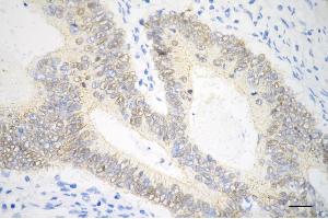 Immunohistochemistry was performed on paraffin-embedded human sigmoid colon carcinoma using catenin beta 1 antibody (ABIN7797936), 1:200). (Recombinant beta Catenin antibody)