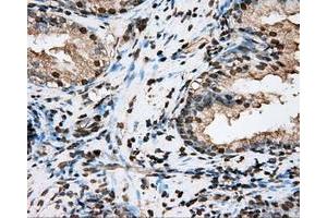 Immunohistochemical staining of paraffin-embedded Adenocarcinoma of ovary tissue N93ing anti-BSG mouse monoclonal antibody. (CD147 antibody)