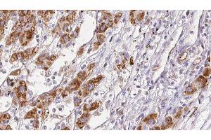 ABIN6278051 at 1/100 staining Human liver cancer tissue by IHC-P. (Angiotensin II Type 2 Receptor antibody)