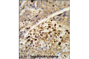 Formalin-fixed and paraffin-embedded human hepatocarcinoma reacted with NR1I2 Antibody , which was peroxidase-conjugated to the secondary antibody, followed by DAB staining. (NR1I2 antibody  (AA 100-127))