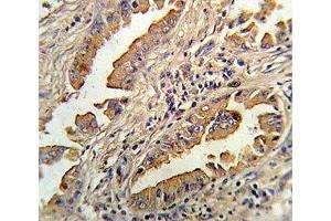 IHC analysis of FFPE human lung carcinoma stained with IL-8 antibody (IL-8 antibody  (AA 72-99))