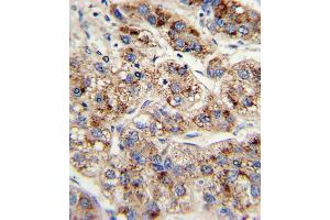 Formalin-fixed and paraffin-embedded human hepatocarcinoma with EHHADH Antibody , which was peroxidase-conjugated to the secondary antibody, followed by DAB staining. (EHHADH antibody  (C-Term))