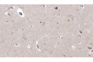 ABIN6273038 at 1/100 staining Human brain cancer tissue by IHC-P. (CYP26B1 antibody  (Internal Region))