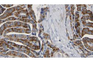 ABIN6267164 at 1/100 staining Human thyroid cancer tissue by IHC-P. (DLG4 antibody  (pSer295))