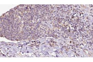 ABIN6273151 at 1/100 staining Human lymph cancer tissue by IHC-P.
