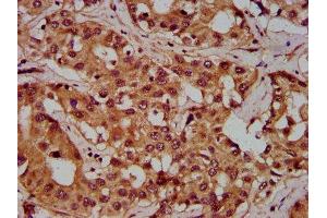 IHC image of ABIN7162774 diluted at 1:300 and staining in paraffin-embedded human liver cancer performed on a Leica BondTM system. (PGLYRP1 antibody  (AA 22-196))