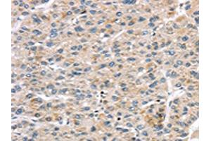The image on the left is immunohistochemistry of paraffin-embedded Human liver cancer tissue using ABIN7191331(LZTS1 Antibody) at dilution 1/20, on the right is treated with synthetic peptide. (LZTS1 antibody)