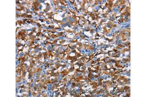 Immunohistochemistry of Human gastric cancer using CD226 Polyclonal Antibody at dilution of 1:60