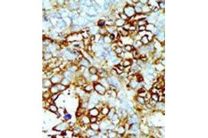 Formalin-fixed and paraffin-embedded human cancer tissue reacted with the primary antibody, which was peroxidase-conjugated to the secondary antibody, followed by AEC staining. (MAP4K2 antibody  (Middle Region))