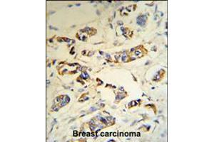 C1QA Antibody (RB18692) IHC analysis in formalin fixed and paraffin embedded human breast carcinoma tissue followed by peroxidase conjugation of the secondary antibody and DAB staining.