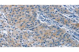 Immunohistochemistry of paraffin-embedded Human gastric cancer tissue using BMPR1B Polyclonal Antibody at dilution 1:30 (BMPR1B antibody)