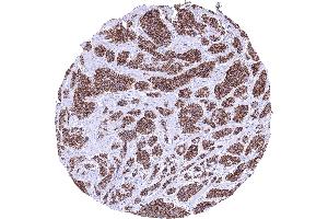 Ileum Neuroendocrine tumor with strong CDH17 immunostaining of all tumor cells CDH17 immunohistochemistry (LI Cadherin antibody  (AA 242-418))