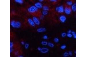 Immunofluorescence analysis of Human liver cancer tissue using CST3 Monoclonal Antibody at dilution of 1:200. (CST3 antibody)
