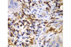 Immunohistochemistry of paraffin-embedded Human liver cancer using HCLS1 Polyclonal Antibody at dilution of 1:100 (40x lens). (HCLS1 antibody)