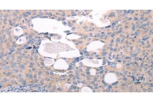 Immunohistochemistry of paraffin-embedded Human cervical cancer tissue using ABCF1 Polyclonal Antibody at dilution 1:40 (ABCF1 antibody)