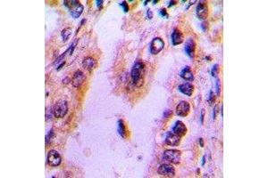 Immunohistochemical analysis of Recoverin staining in human lung cancer formalin fixed paraffin embedded tissue section. (Recoverin antibody)