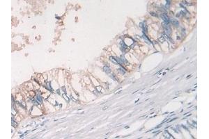 Detection of MSTN in Human Colorectal cancer Tissue using Polyclonal Antibody to Myostatin (MSTN)