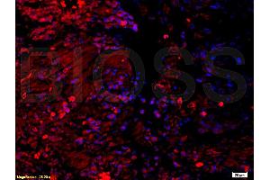 Formalin-fixed and paraffin embedded: human rectal carcinoma labeled with Anti-14-3-3 Polyclonal Antibody (ABIN726710) at 1:200,, followed by conjugation to the secondary antibody was Goat Anti-Rabbit IgG, PE conjugated at 1:200 for 40 minutes at 37°C (14-3-3 Pan (AA 174-245) antibody)