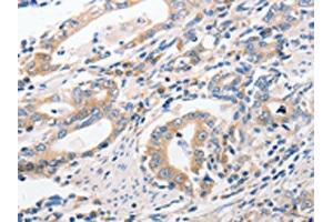 The image on the left is immunohistochemistry of paraffin-embedded Human gastic cancer tissue using ABIN7191756(P2RY11 Antibody) at dilution 1/40, on the right is treated with synthetic peptide. (P2RY11 antibody)