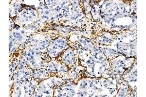 ABIN6265163 and ABIN6272472 at 1/100 staining Human lung cancer by IHC-P. (Transgelin antibody  (C-Term))